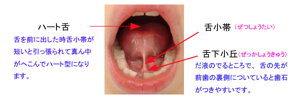 舌小帯短縮